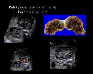 Des reins normaux aux reins pathologiques
