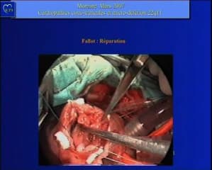 Malformations cono-troncales et délétion 22q11