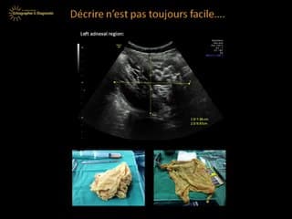Quoi de neuf dans l'échographie du bilan ovarien de fertilité