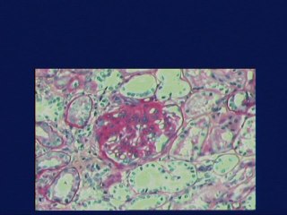 L’échographie peut-elle contribuer au diagnostic des syndromes néphrotiques congénitaux ?
