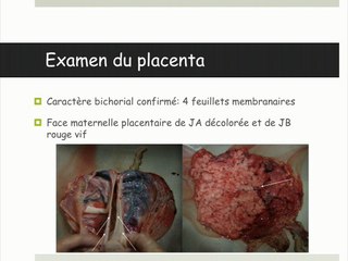 48 TAPS et Grossesse gemellaire Bichoriale Bi Amniotique