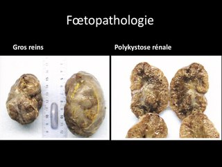 Néphropathies: cas cliniques de ciliopathies