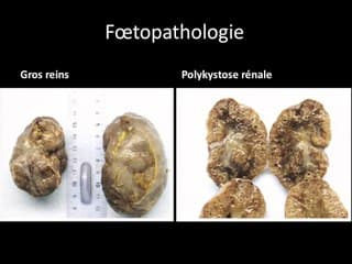 Néphropathies: cas cliniques de ciliopathies