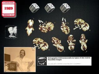 Histoire et petites histoires de l'échographie obstétricale française