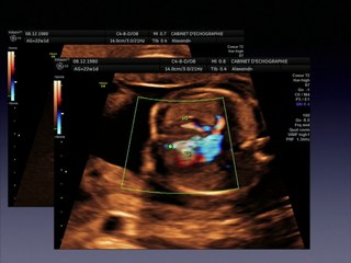 Ventricule unique atrésie tricuspide