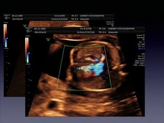 Ventricule unique atrésie tricuspide