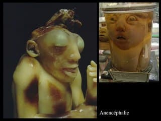 CRANIOSTÉNOSE / DIAGNOSTIC DES ANOMALIES CRÂNIO-FACIALES SURRESTESANCIENS(SQUELETTES,MOMIES,MASQUES MORTUAIRES...)