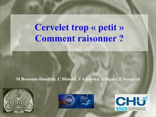 Cerveau foetal I : c’est trop petit ! Les petits cervelets et petits vermis