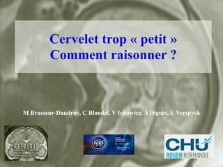 Cerveau foetal I : c’est trop petit ! Les petits cervelets et petits vermis