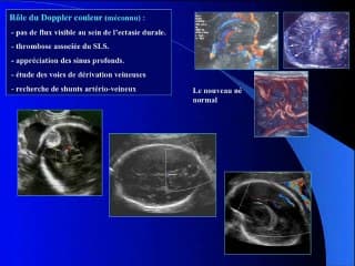 Thromboses veineuses cérébrales.
