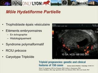 46 Placentas Lacunaires en Echographie. Quels examens pour quels diagnostics ?