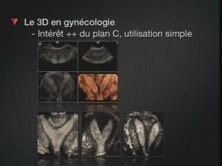 La place de l'échographie 3D en gynécologie-obstétrique Le contre