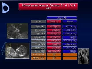 Dépistage des anomalies chromosomiques : OPN (os propre du nez)