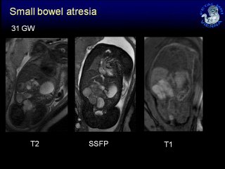 IRM du tube digestif foetal  ( en ANGLAIS )