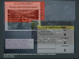 Le Doppler utérin et sa signification tout au long de la grossesse
