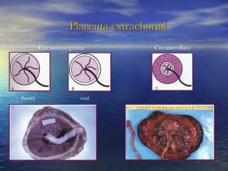 EPR et insertion placentaire