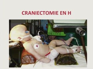 Déformations du crâne : plagiocépahlie souvent, craniosténose rarement.