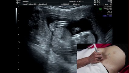 Démonstration live : Mesure du doppler utérin au 1er trimestre de la grossesse.