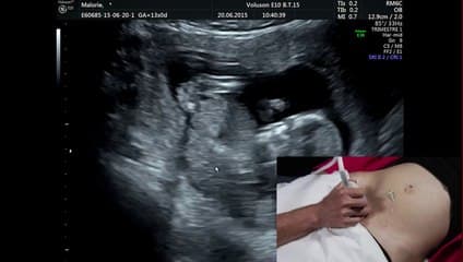 Démonstration live : Mesure du doppler utérin au 1er trimestre de la grossesse.