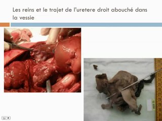 dysplasie renale