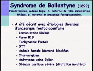 Syndrome de Ballantyne