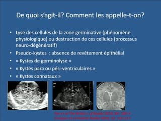 Pseudokystes sous-épendymaires : de quoi parle-t-on ? Faut-il en parler ?