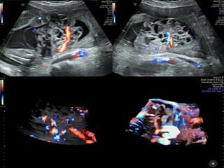 Dysplasie mesenchymateuse