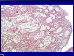 Néphropathies foetales