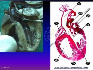 Coeur foetal en dépistage