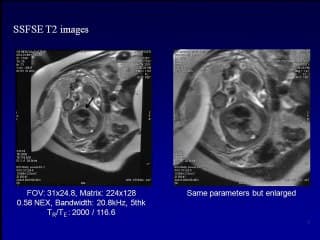 irm du coeur foetal ( en ANGLAIS )