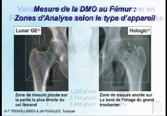 Comment interpréter une ostéodensitométrie