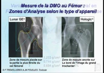 Comment interpréter une ostéodensitométrie
