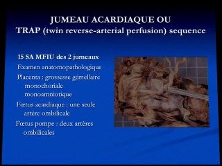 Jumeau acardiaque