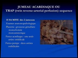 Jumeau acardiaque