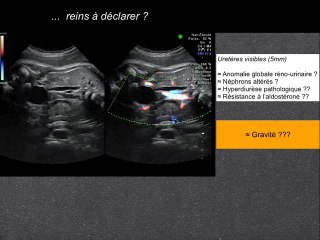 Oligonephronie CAKUT RCS renal colobome syndrome