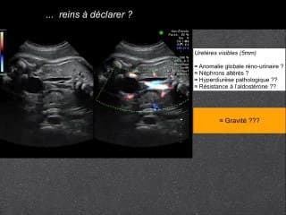 Oligonephronie CAKUT RCS renal colobome syndrome