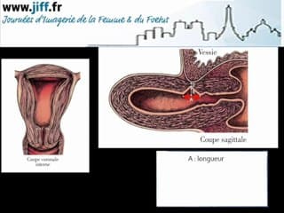 PATHOLOGIE DE LA CICATRICE : Échographie de cicatrice hors grossesse : comment optimiser le diagnostic d’isthmocèle ?