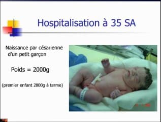 Syndrome de Cornelia Delange