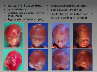 Imagerie du rhomboencéphalosynapsis