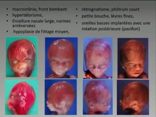 Imagerie du rhomboencéphalosynapsis