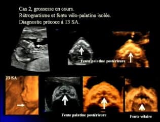 Echographie 3D des fentes vélopalatines