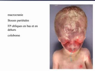 Dystose mandibulo faciale (syndrome de Franceschetti)