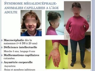 Syndrome mégalencéphalie – malformations capillaires : variabilité du phénotype à propos de deux cas cliniques.