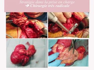 Les ultrasons focalisés à Haute Intensité (HIFU) dans l’endométriose profonde : une alternative à la chirurgie ?