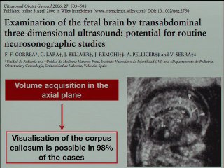 volume du cerveau foetal en 3D  ( en ANGLAIS )