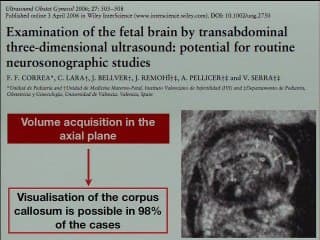 volume du cerveau foetal en 3D  ( en ANGLAIS )