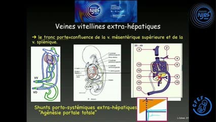 Coeur foetal II : c’est trop gros ! Gros coeur et agénésie de l’Arantius