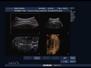 os foetal live  ( en ANGLAIS )