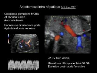 Les agénésies ductales