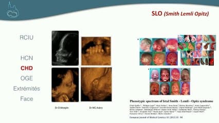 Le cœur de la face › Anomalies cardiaques associées aux anomalies de la face